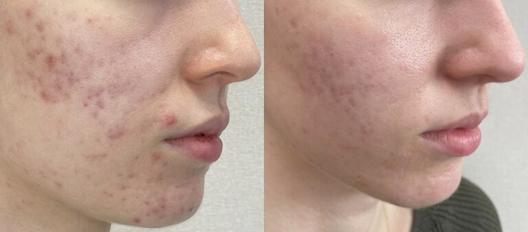najnowsze metody leczenia trądziku