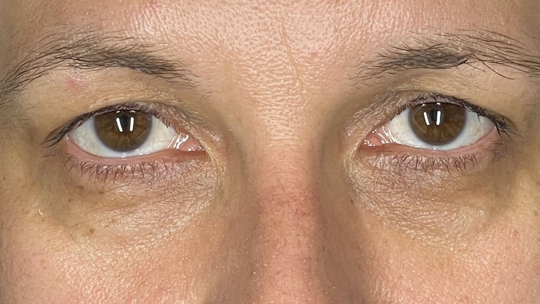 dolina łeż po zabiegu