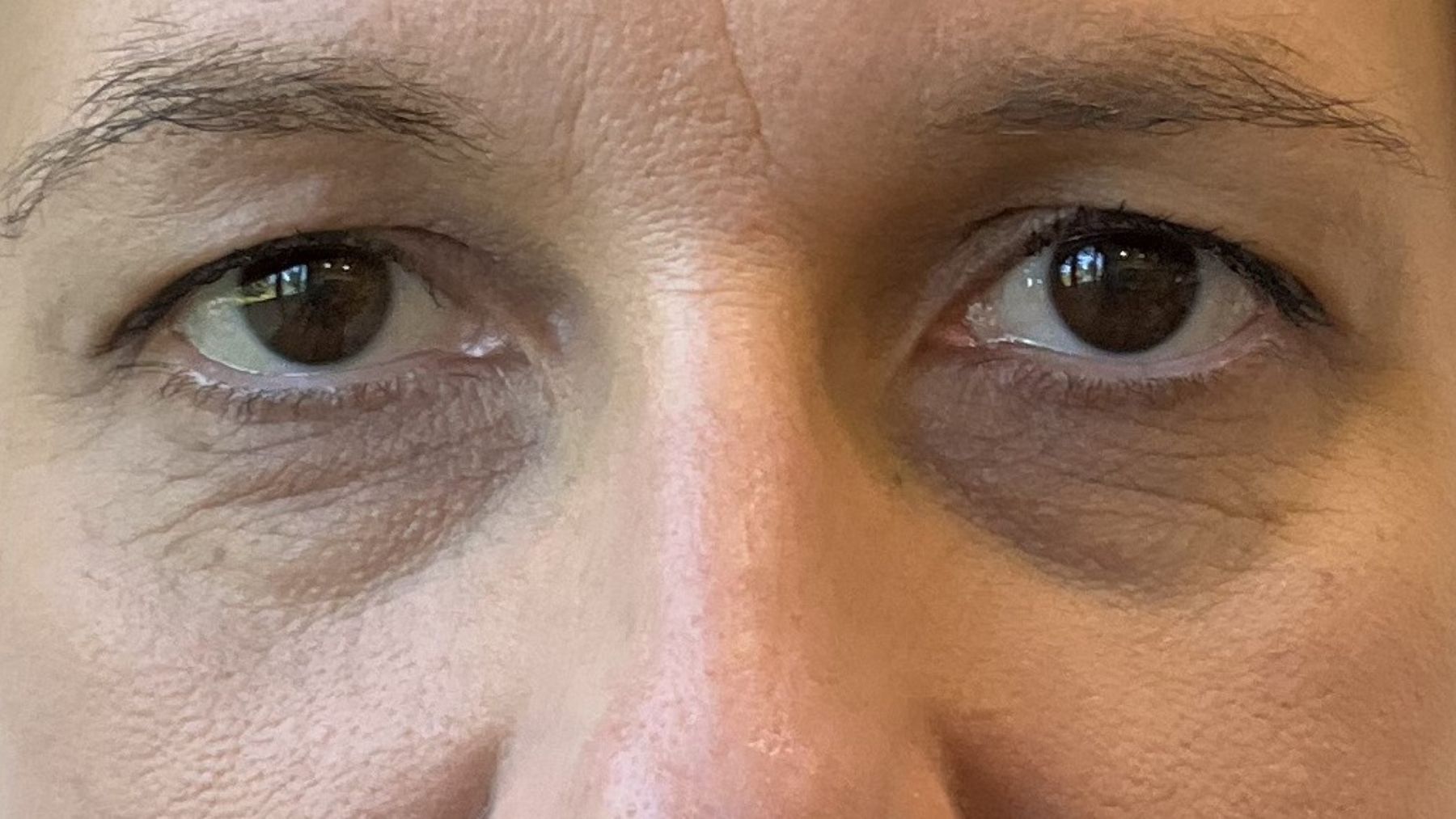 dolina łez przed zabiegiem