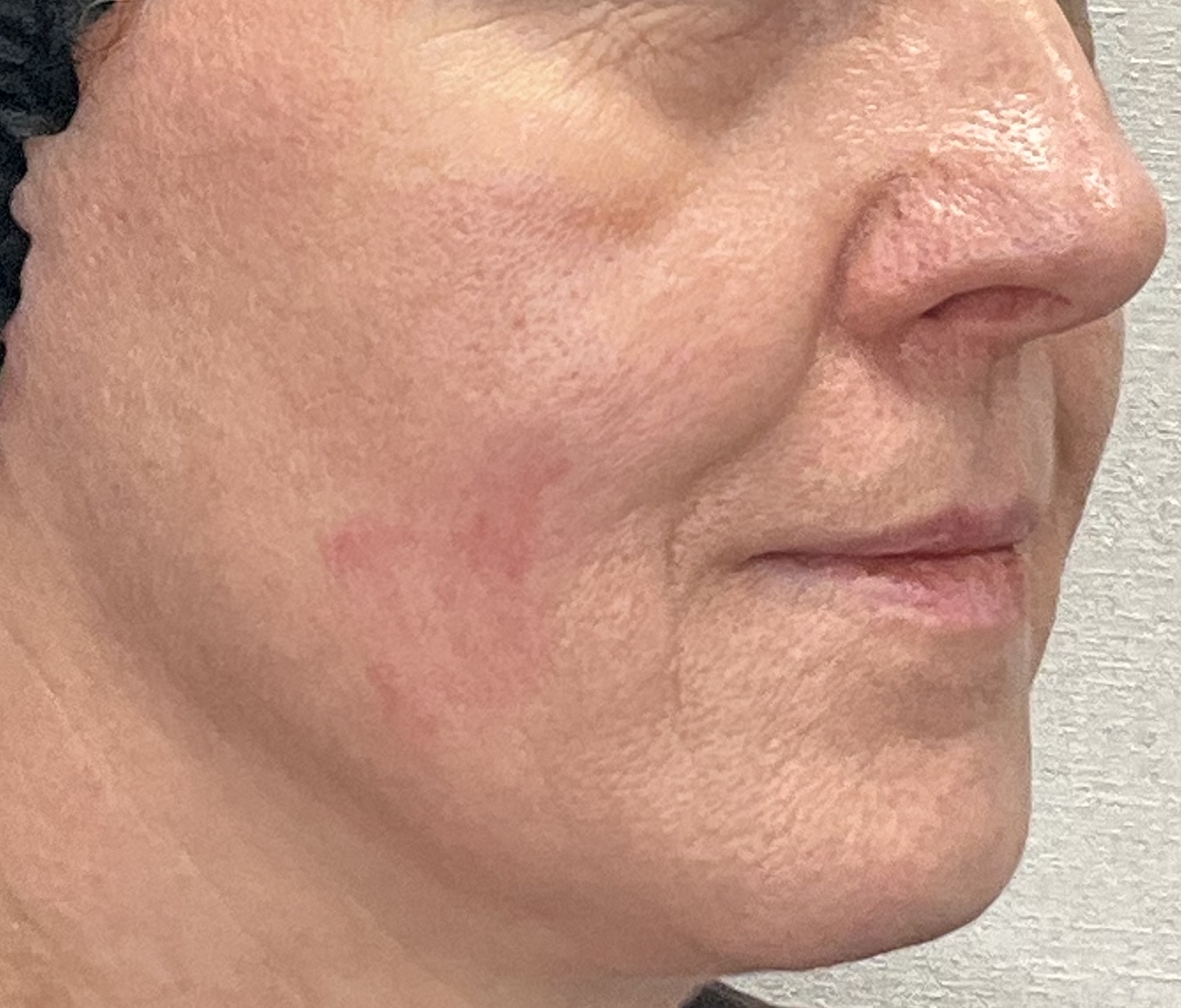 laserowe zamykanie naczynek po zabiegu