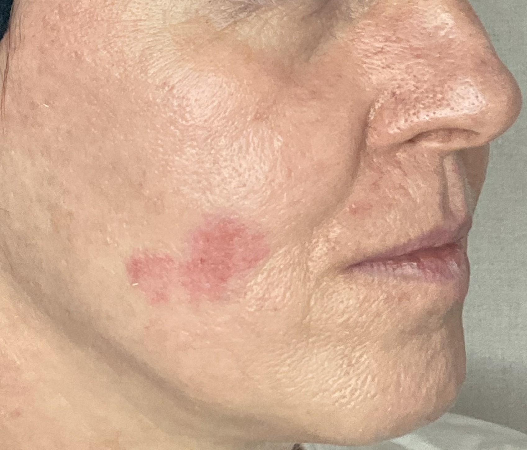 laserowe zamykanie naczynek przed zabiegiem