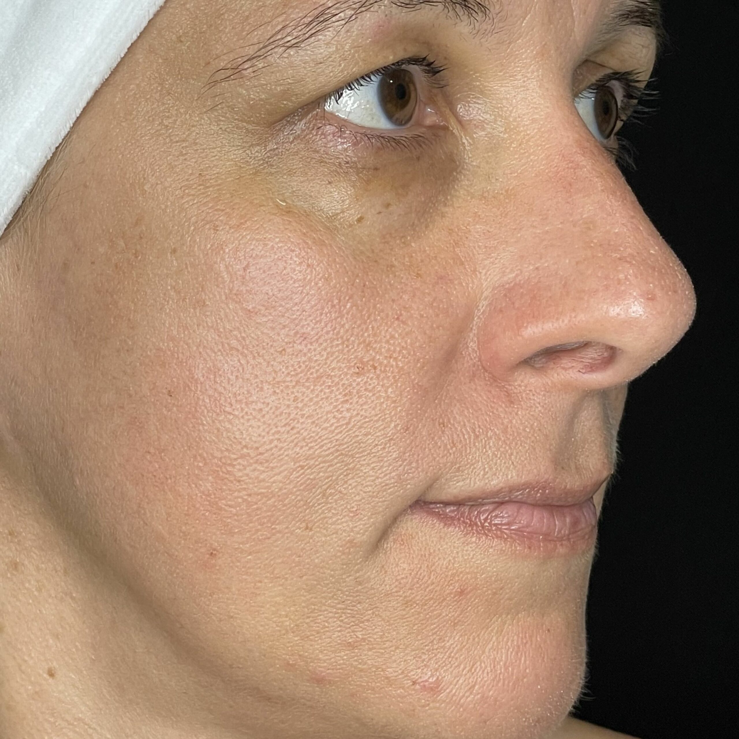 lipotransfer efekt po zabiegu