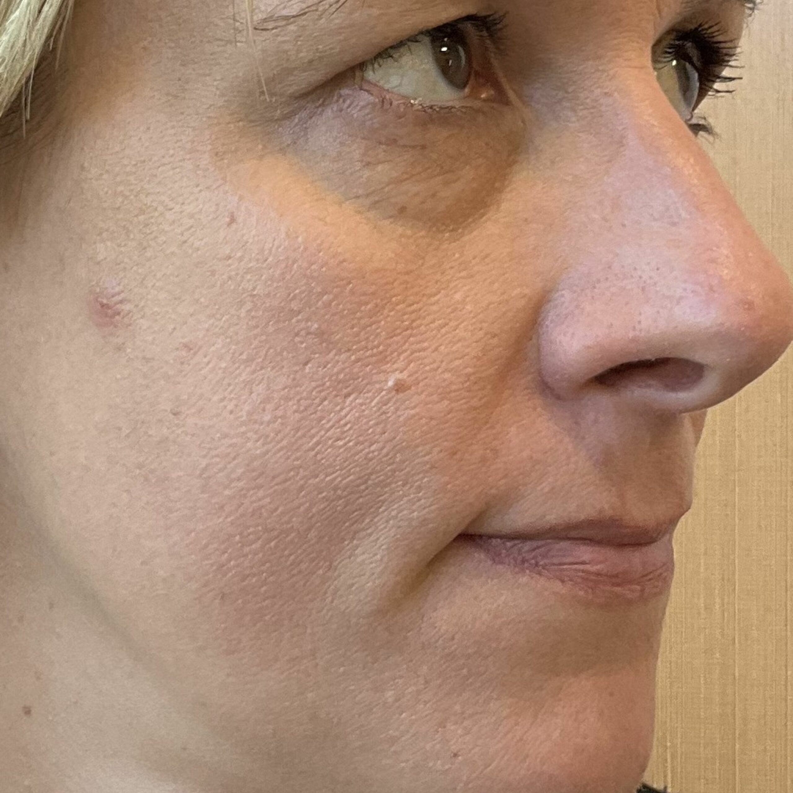 lipotransfer efekt przed zabiegiem