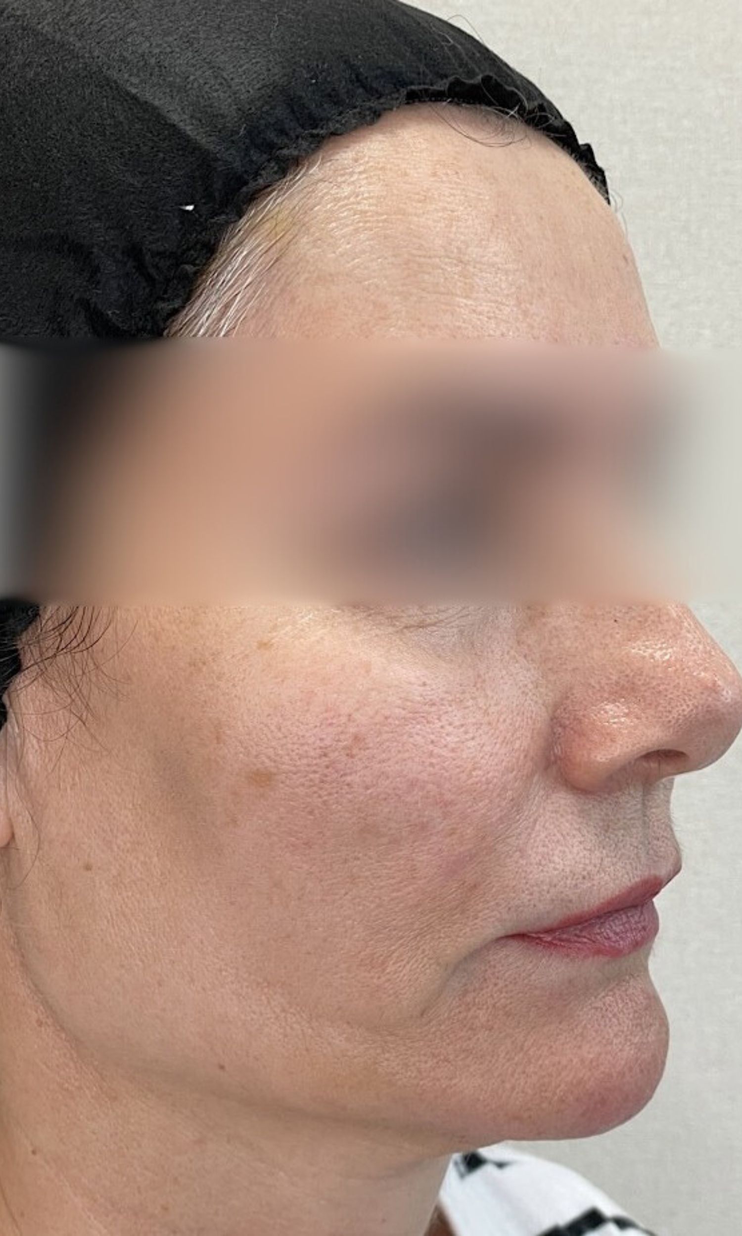 nici aptos efektu zabiegu po