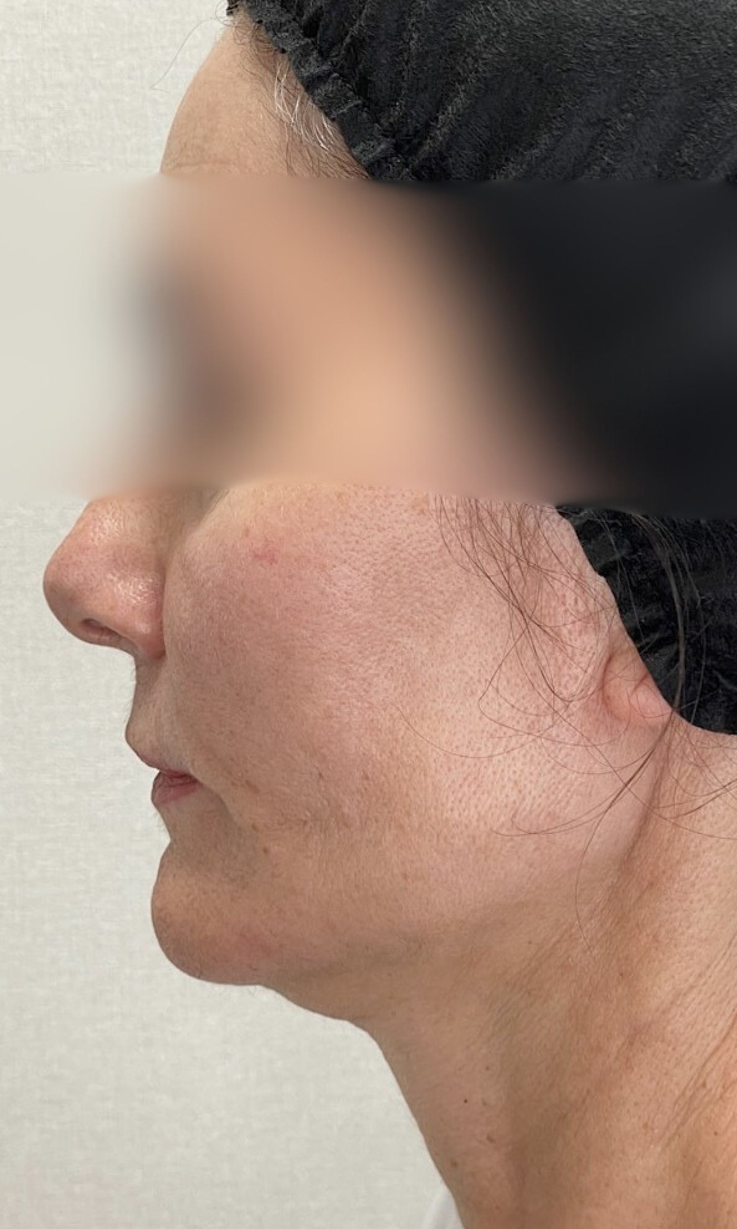 nici aptos efektu zabiegu po