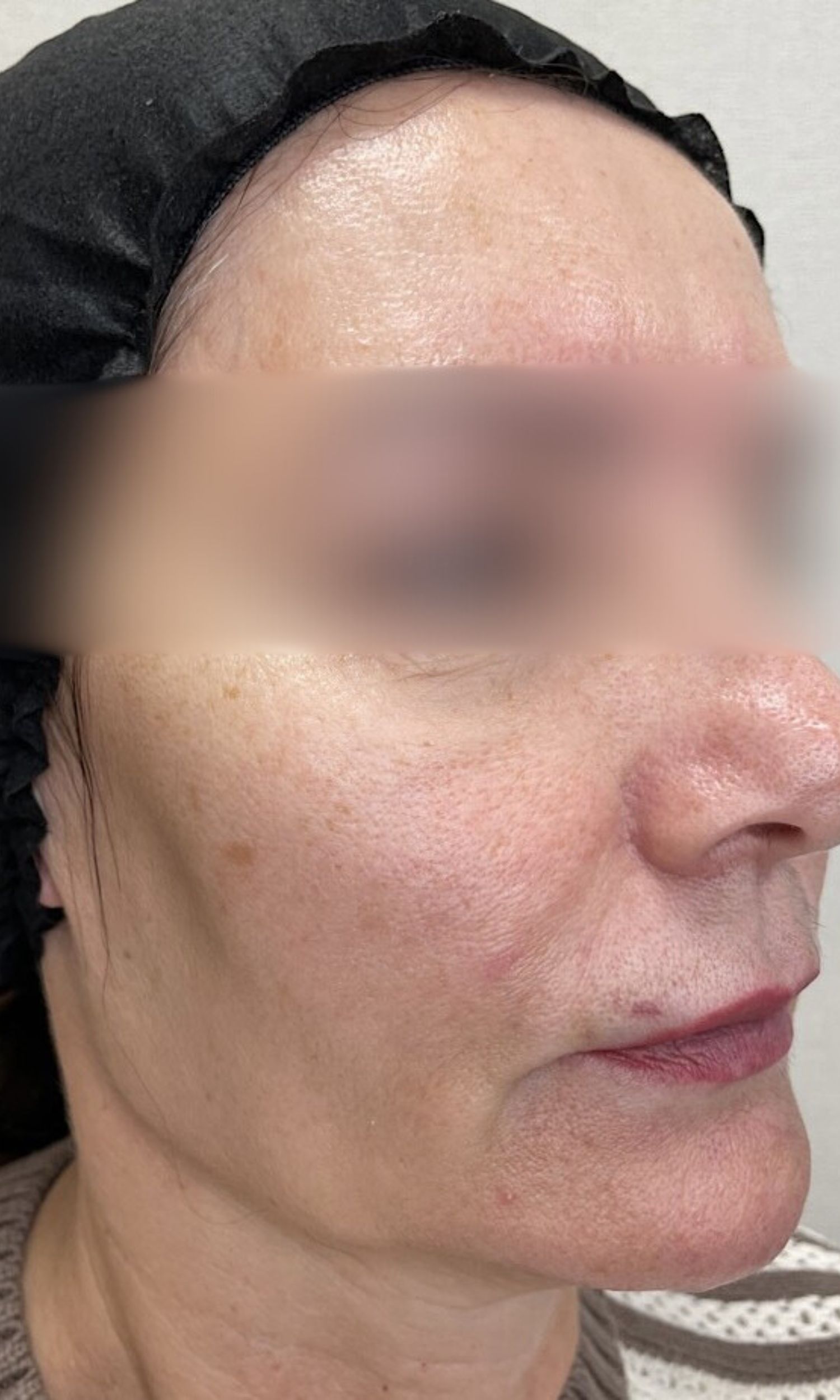 nici aptos efektu zabiegu przed