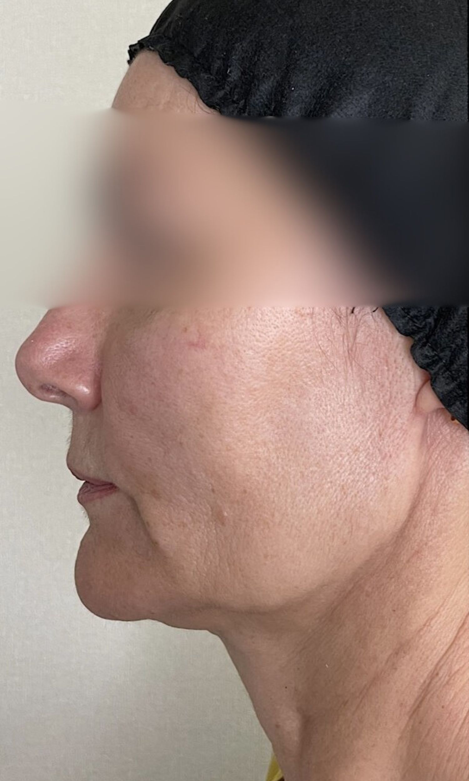 nici aptos efektu zabiegu przed