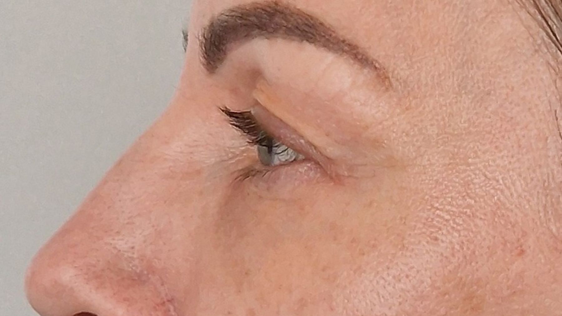 plastyka powiek dolnych po zabiegu