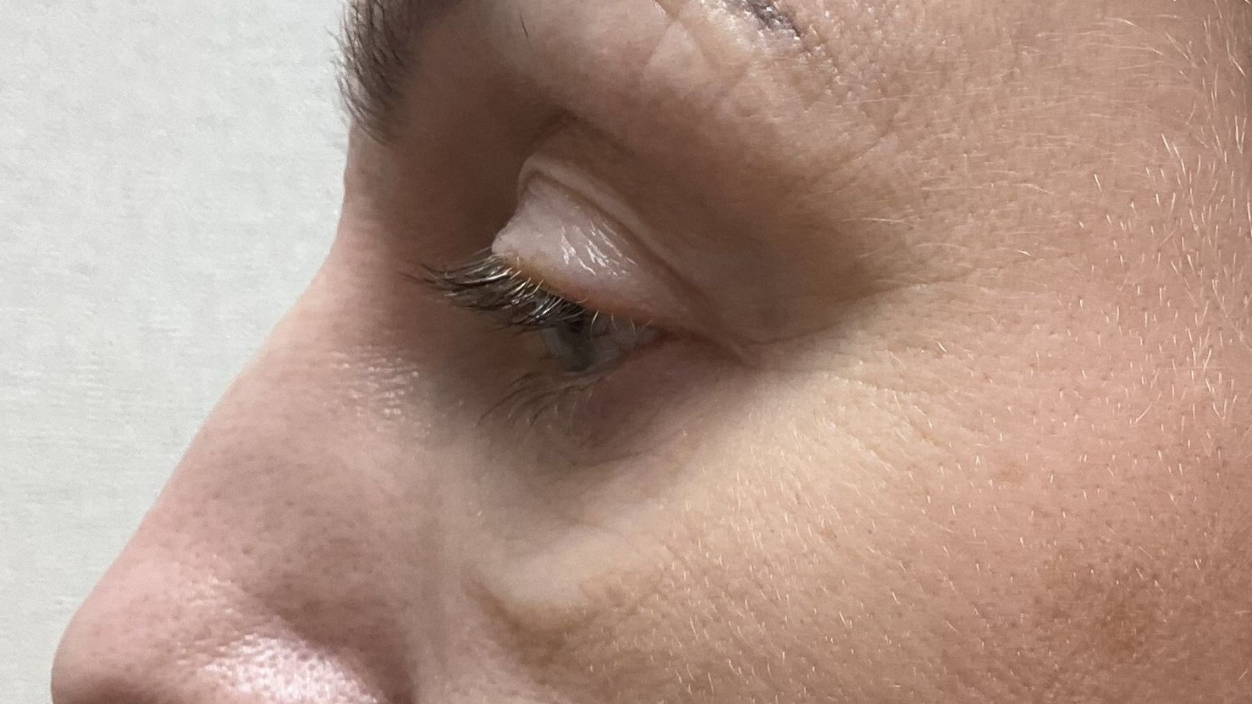 plastyka powiek dolnych przed zabiegiem