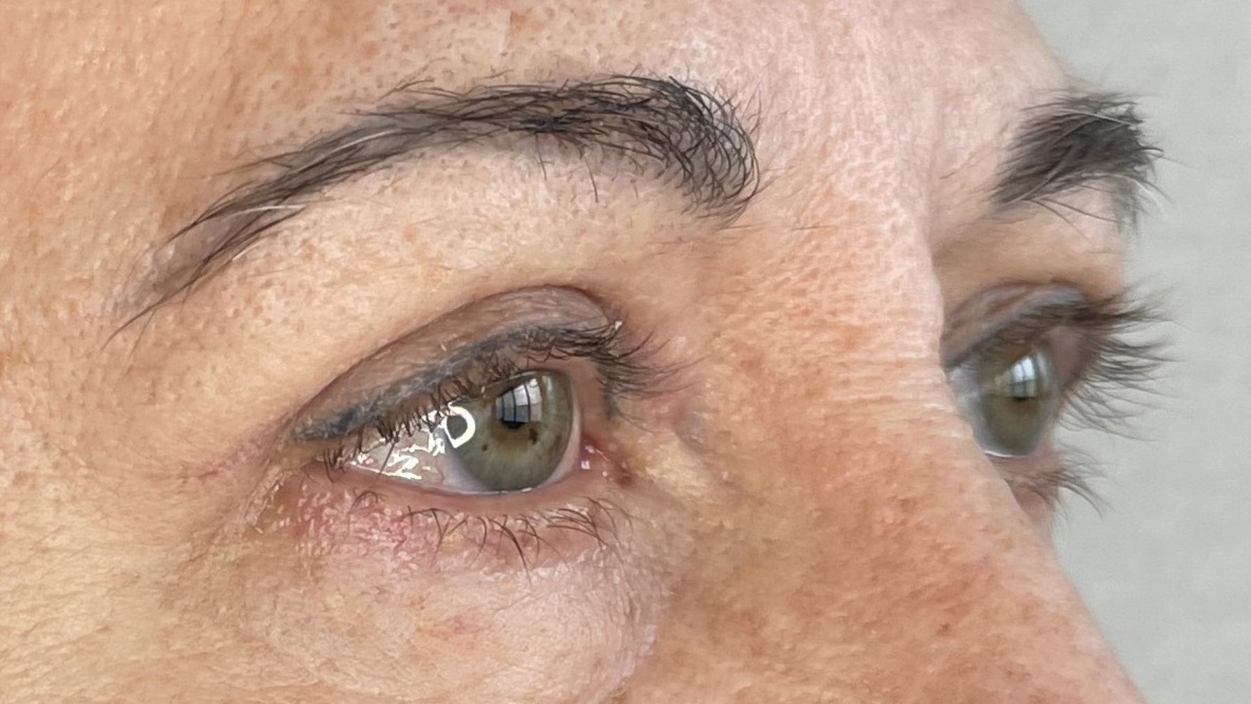 plastyka powiek górnych efekt po zabiegu