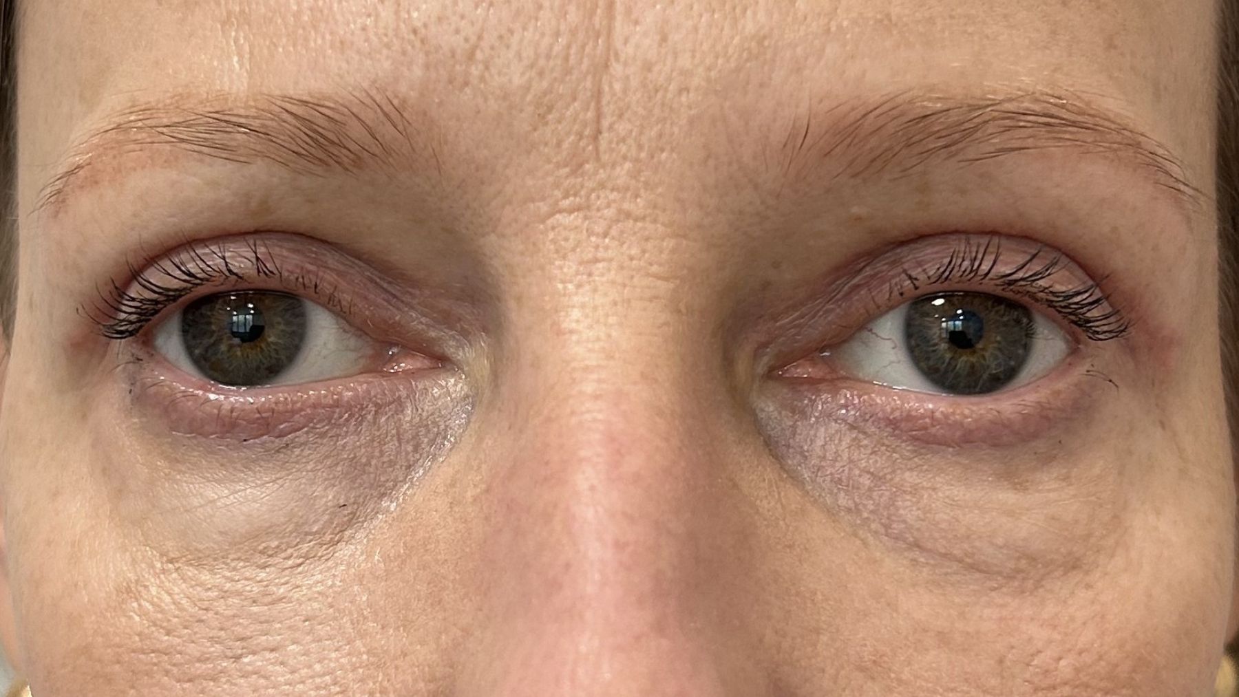 blefaroplastyka efekt po zabiegu