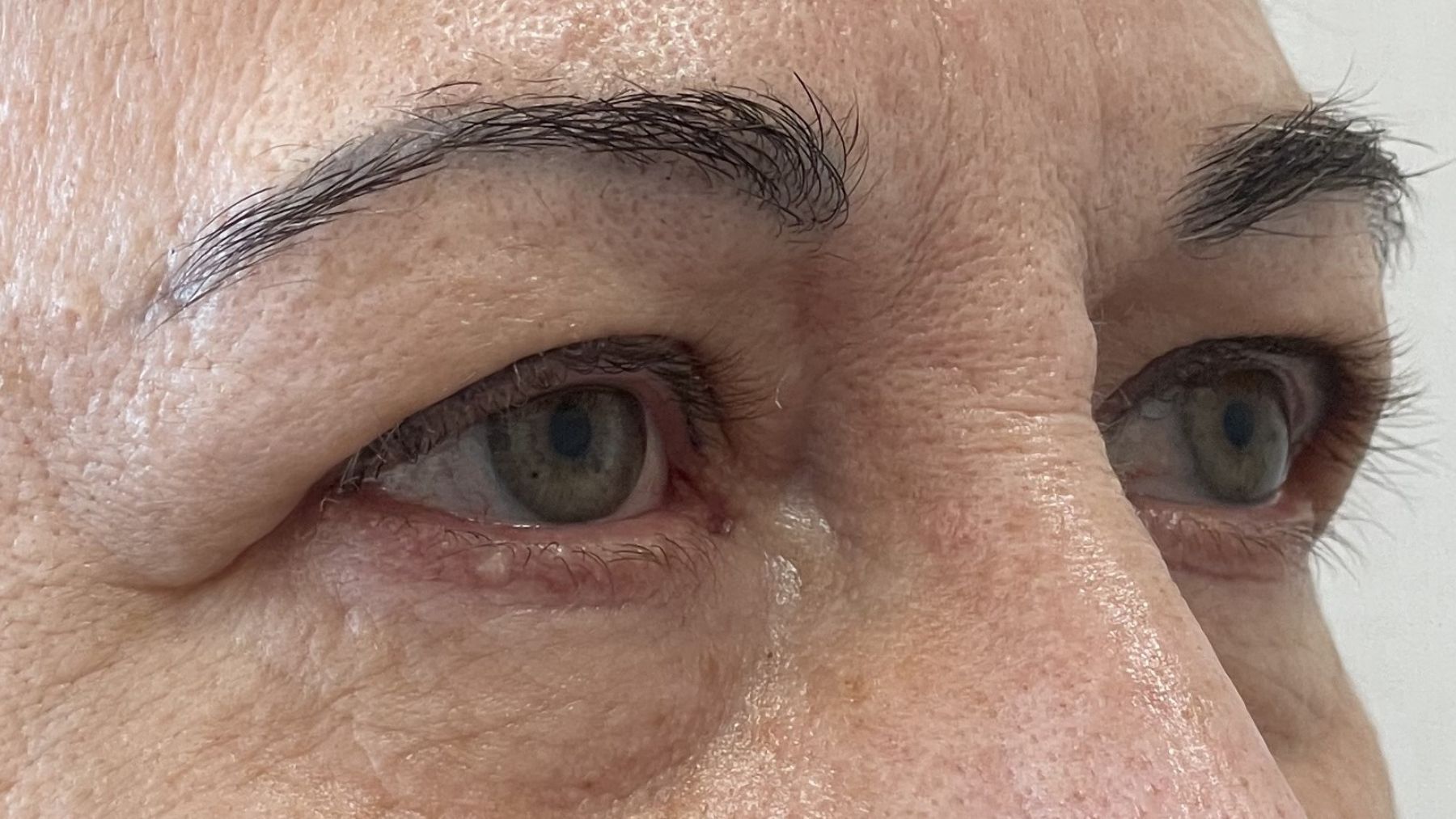 plastyka powiek górnych efekt przed zabiegiem