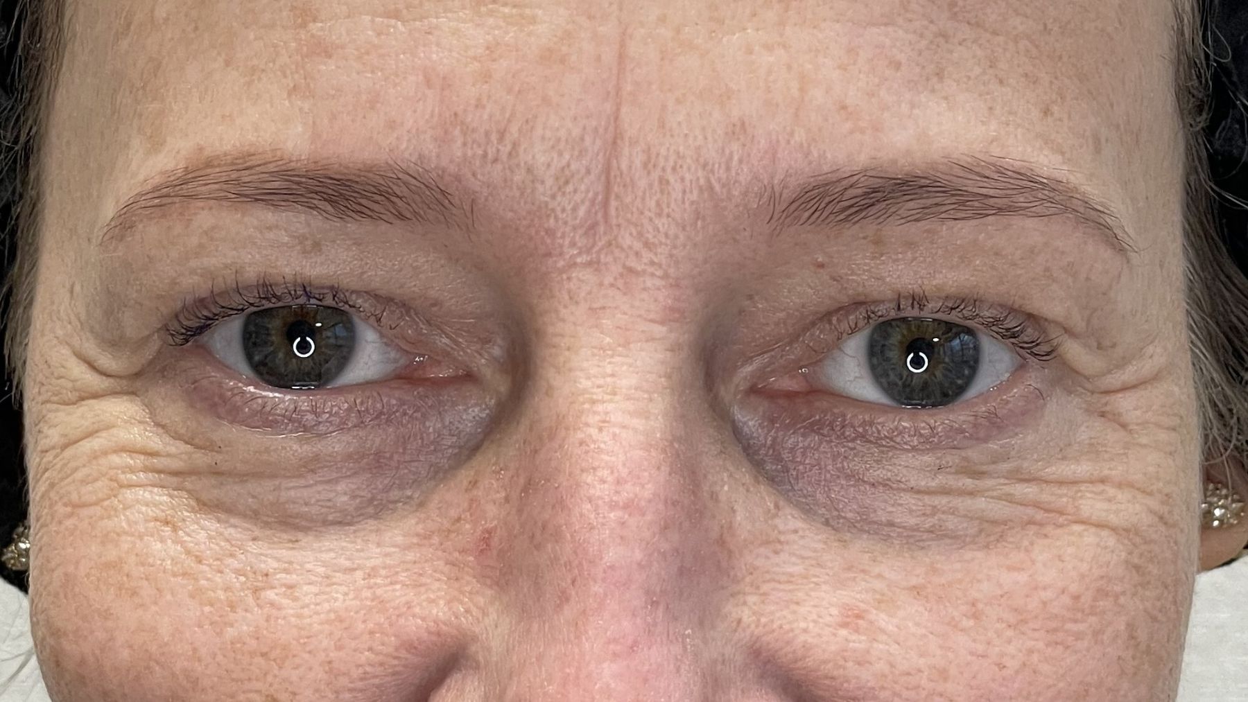 blefaroplastyka przed zabiegiem