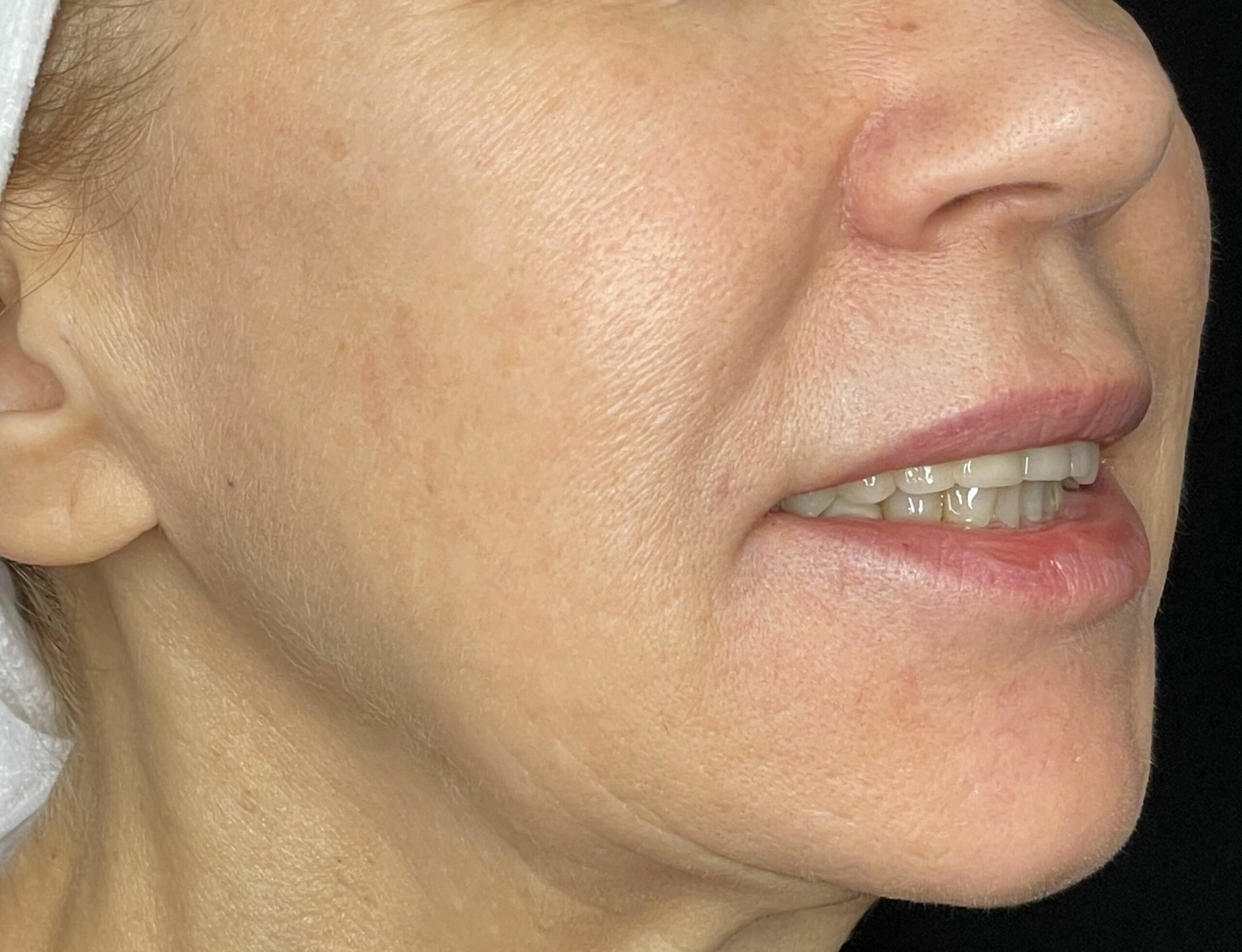 stymulatory tkankowe efekt po zabiegu