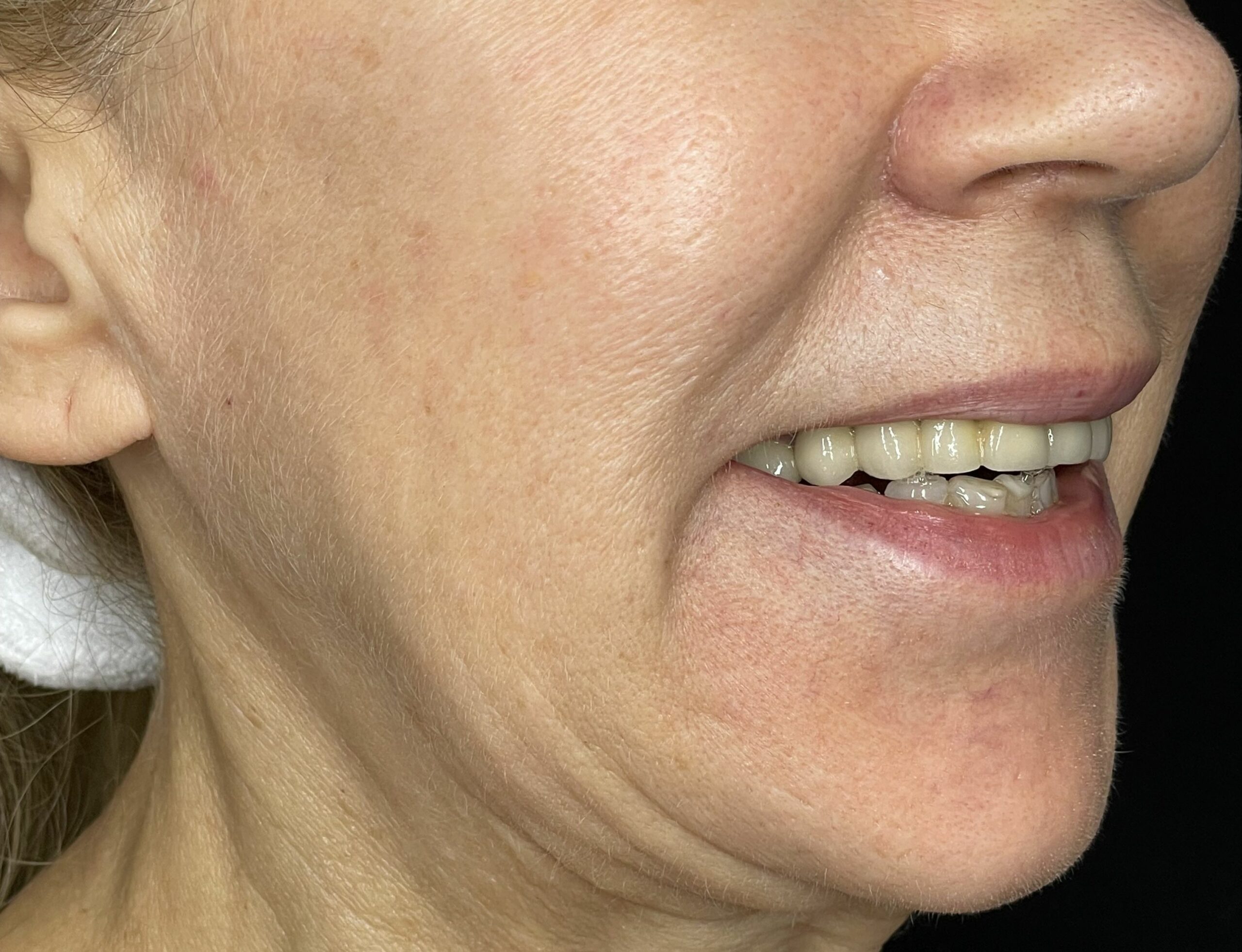 stymulatory tkankowe przed zabiegiem