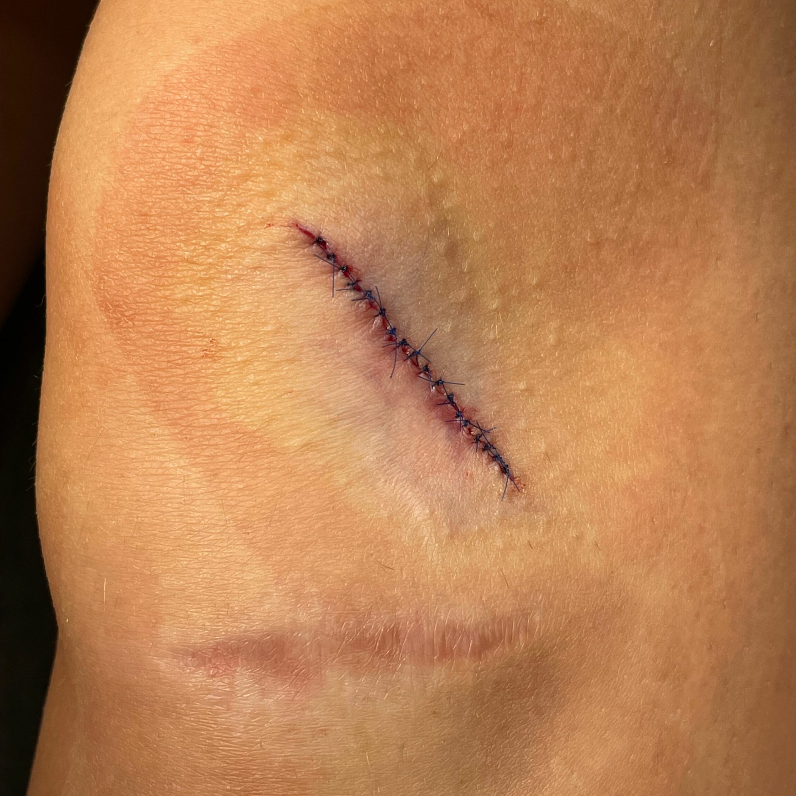 Chirurgiczne usuwanie zmian skórnych po