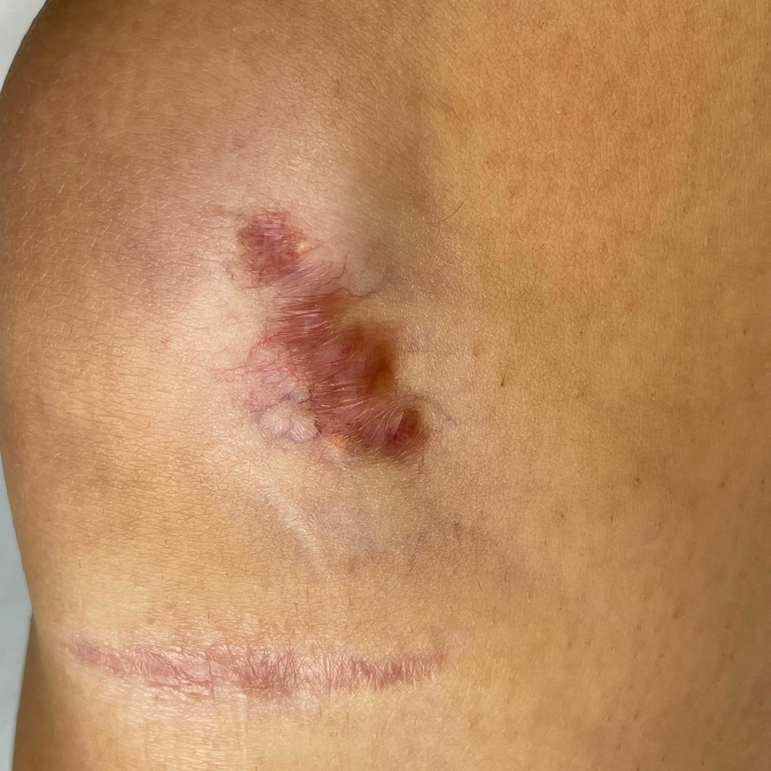 Chirurgiczne usuwanie zmian skórnych przed